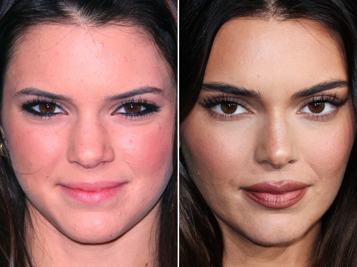 Kendall Jenner Before And After: From 2008 To 2022 - The Glow Memo