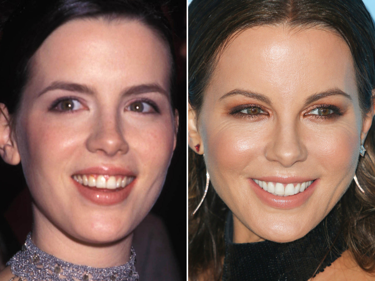 Kate Beckinsale Before and After - The Glow Memo